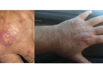 Especialistas alertam para a falta de informação sobre a leishmaniose