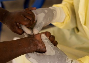 Brasil registra 88 casos de Mpox em 2026; saiba como evitar a doença